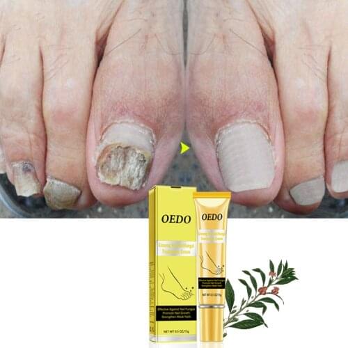 Profession Ginseng Nail Treatments Cream Remove Onychomycosis Fungus Paronychia Promote Nail Growth Foot Cream Nail Care 15ml