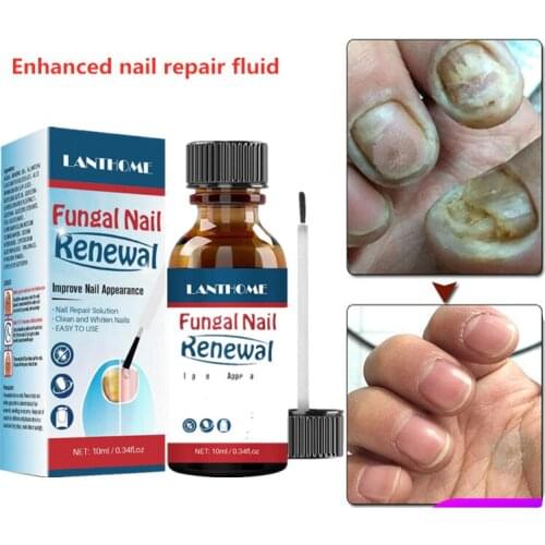 10ML Fungal Nail Treatment Feet Care Essence Nail Foot Whitening Toe Fungus Removal Gel Anti Infection Paronychia Onychomycosis