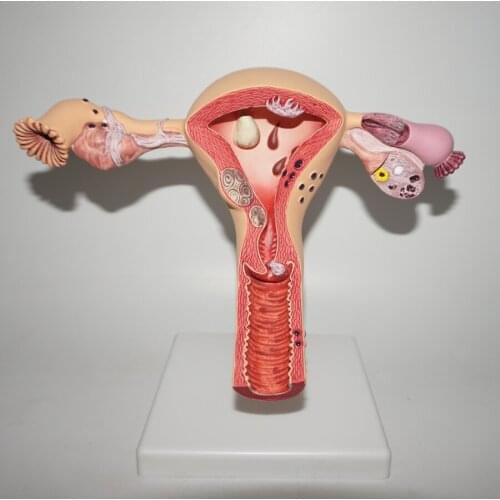 Human Uterus Model Sick Uterus Model Teaching Model class display clinic display Speech aids