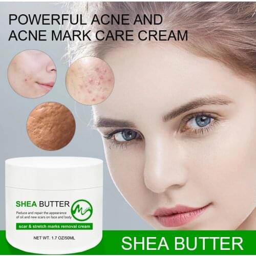 Minch Shea Butter Cream Effective Acne Removal Cream Acne Treatment Fade Acne Spots Oil Control Shrink Pores Whitening Skin Care