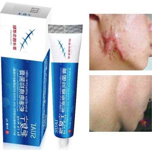 Acne Scar Remover Whitening Cream Fade Stretch Marks Pimple Spots Anti-Acne Treatment Smoothing Repairing Body Skin Care 20ml