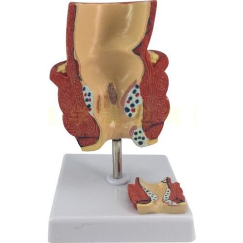 Rectal hemorrhoids pathological model Internal and external anatomy hemorrhoids Anorectal Colorectal pathological model