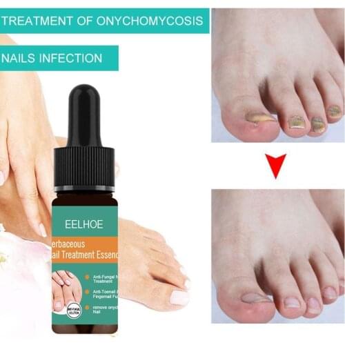 10/30Ml Onychomycosis Liquid Hand And Foot Onychomycosis Treatments Repair Antibacterial Care Nail And Thickening P9N5