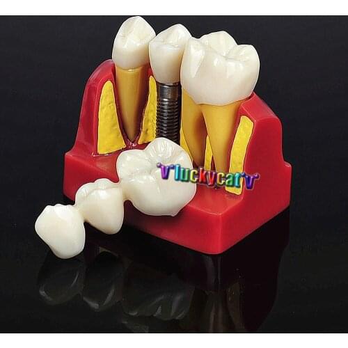 1 Set Dental Implant Analysis Crown Bridge Demonstration Dental Teeth Model for dental teaching