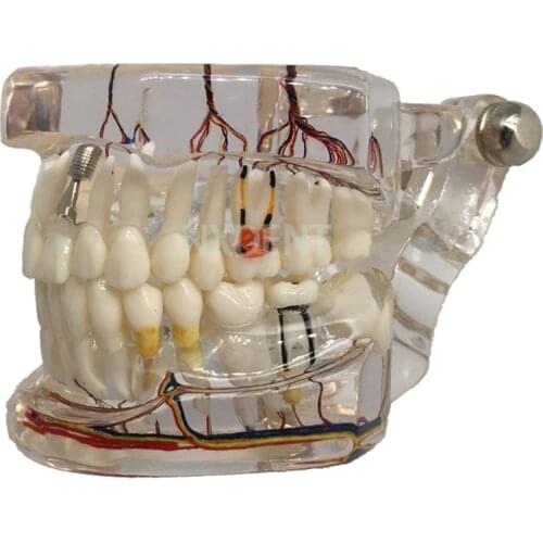 New Dental Teaching Teeth Model with Nerve Implanted Transparent Pathological Repair Teaching Demonstration model