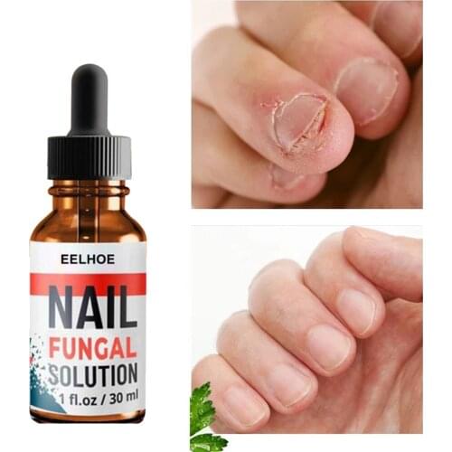 Nail Fungal Treatment Feet Care Essence Nail Foot Whitening Toe Nail Fungus Removal Gel Anti Infection Paronychia Onychomycosis