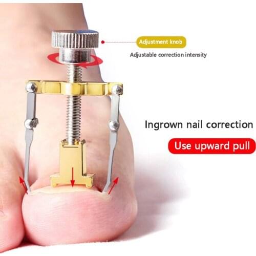 Ingrown Toenail Correction Pedicure Foot Toe Nail Care Straightening Clip Brace Corrector Ingrown Toe Nail Fixer Nail Correction