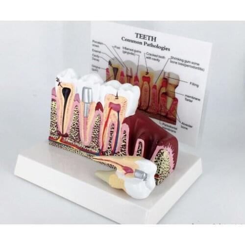 Teeth common pathologies model oral model detachable tooth anatomical dental teaching model