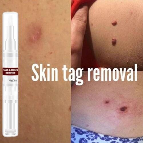 3ml Gram Wart Liquid Bran Beauty Removing Wart Pen G2F8