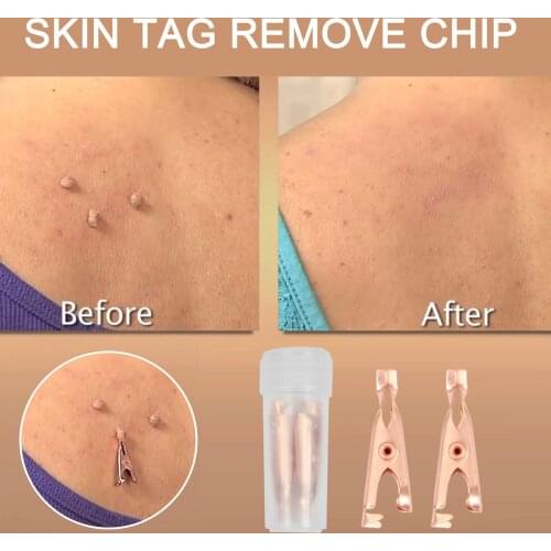 2PCs Skin Tags Remover Small Clip Wart Remover Coppers Tags Out Remover Skin Wart Tags Tattoo Clippers Beauty Removal Tools