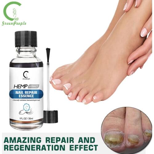 GPGP Nail Treatment Feet Care Essence Nail Foot Whitening Toe Nail Fungus Removal Gel Anti Infection Paronychia Onychomy