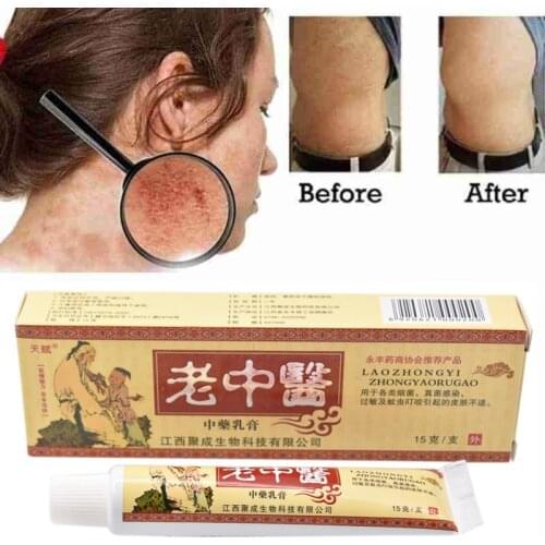 Eczema Ointment laozhongyi 100% Original Powerful Professional Cure Psoriasis Ointment Native Medicine Ingredient Security