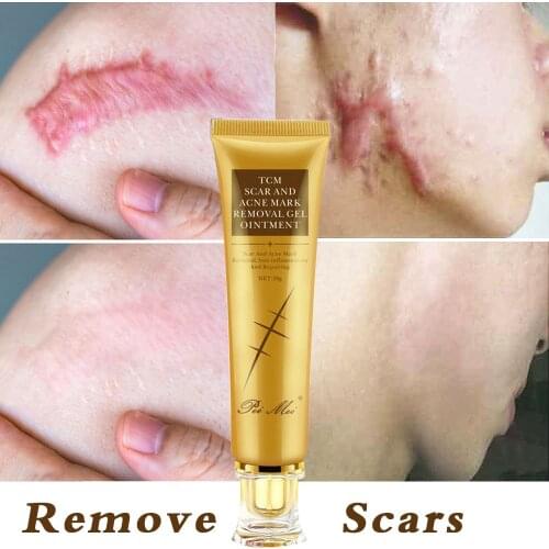 Acne Scar Removal Cream Gel Face Pimples Stretch Marks Cream Repairing Smoothing Whitening Moisturizing Body Cream Skin Care 30g