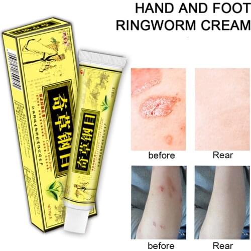 Focallure Skin Psoriasis Cream Dermatitis Eczematoid Eczema Ointment Treatment Moisturizing Repairing Body Skin Care Cream TSLM1