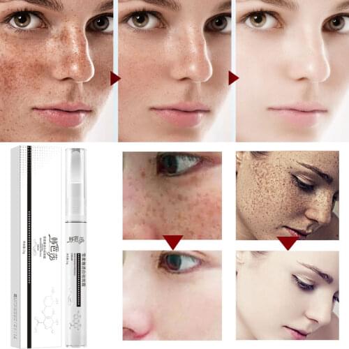 Whitening Cream Whiten Skin Lighten Spots Chloasma Maternal Spots Age Spots Sunburn Sodium Hyaluronate Propyl Paraben 15g