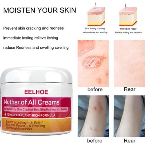 Dermatitis Eczma Cream Works Perfect For All Kinds Of Skin Problems Body Skin Fungus Treatments Chinese Medicine Ointment TSLM1