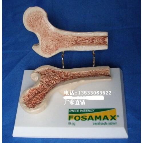 Comparison of femoral profiles (Healthy and loose) Femoral head skeleton Medical teaching model