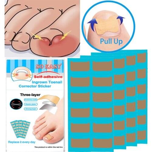 48pcs Ingrown Toenails Correction Patch Straightening Elastic Toenail Pedicure Sticker Brace Bunion Corrector Self Adhesive