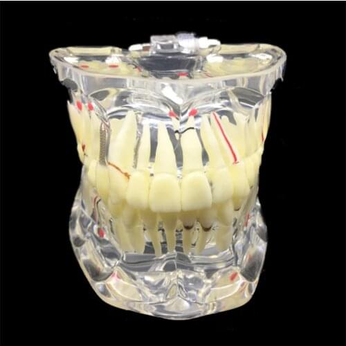 Dental Transparent Adult Pathological Teeth Display Model Disease Teeth Model Dental Lab Equipment Dentist Teaching Model
