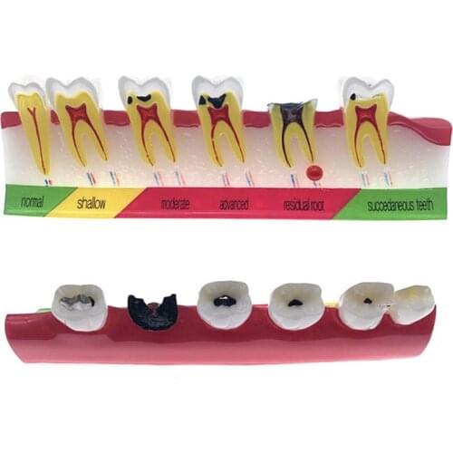 Dental caries classify model Tooth Model of pathological process around teeth Dental teeth caries Evolution decayed Model