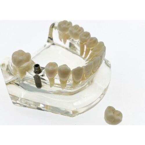 Clear Transparent Dental Implant Teeth Bridge Model Typodont Lower Jaw 2010