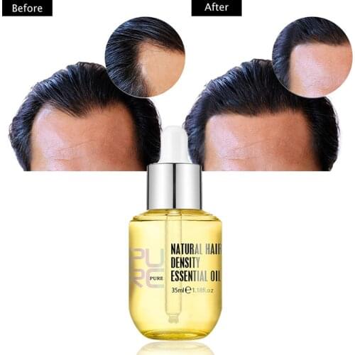 PURC 35ml Ginger Essence For Hair Growth Oil Hair Loss Remedy Hair Scalp Treatments Serum Fast Growing Products For Women Men