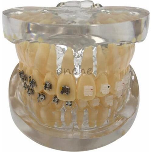1pcs Dental Orthodontics Typodont Teeth Model Half Metal Half Ceramic Brace Bracket Dentist-Patient Communication Model
