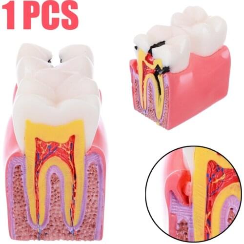1pc Dental Anatomy Education Teeth Model 6 Times Caries Comparation Study Models for Dentist Studying Researching Disease Decay