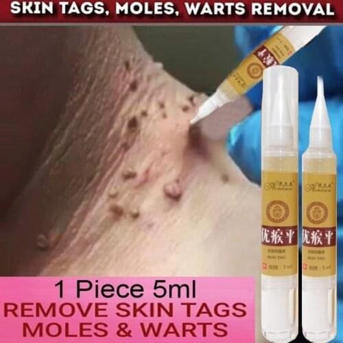 Skin Tag Remover Medical Against Moles 12 Hours Fast Removal Genital Wart Acne Spot Treatment Anti Foot Corn Skin Care Liquid