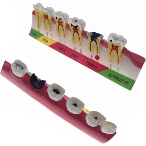 Dental caries classify Tooth Model of pathological process around teeth caries Evolution decayed Model