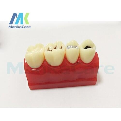 Sealantant Demonstration Imported resin teeth/Sealant and inlay demonstration model in comparison with symmetrical caries