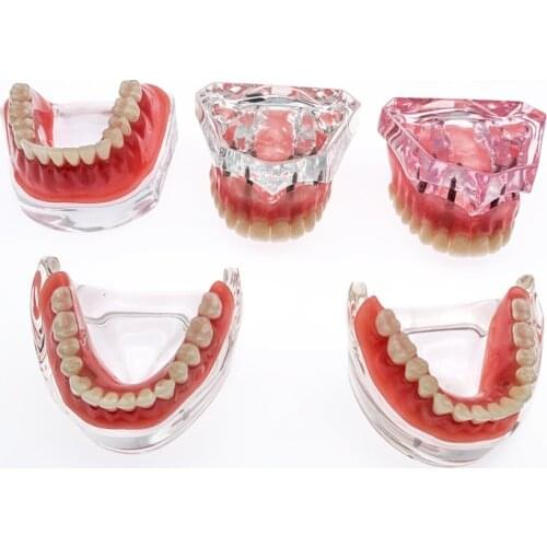 Dental Teeth Model With Implants Overdenture Superior Demo Model For Student Dentist patient communication model