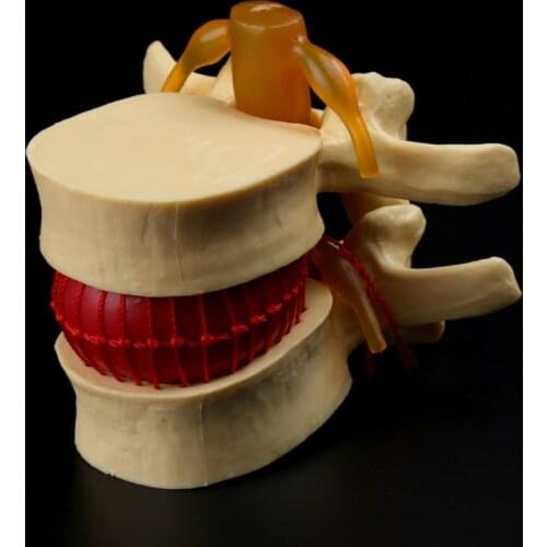Anatomical Spine Lumbar Disc Herniation Anatomy Medical Teaching Tool