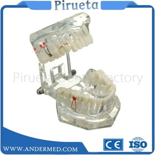 1PcDental Implant Disease Teeth Model With Restoration Bridge Malocclusion Orthodontic Model For Medical Science Dental Research