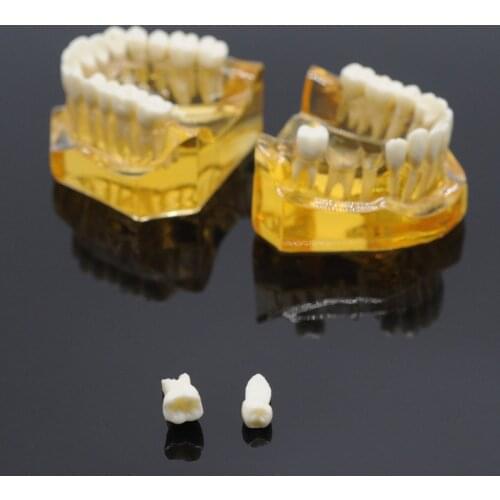Dental Removable Teeth Adult Typodont Model Implant Disease Teeth Dentist Lab Equipment