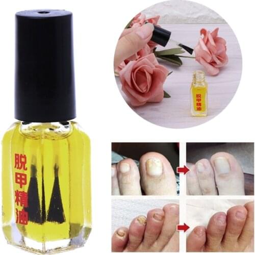 Drop Ship&Wholesale Painless Nail Removal Nail Treatment Repair Nails Care Fungus Essential Oil 5ML Nov.23