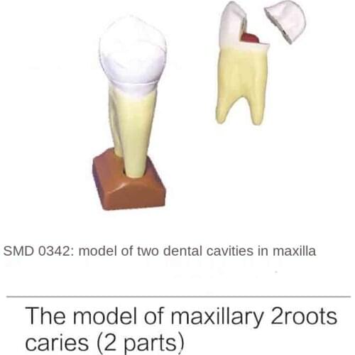 Smd0342 C model of maxillary caries