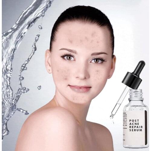 Acne Treatment Face Serum Anti Acne Essence Hydrating Essence Spot Whitening Q8A6