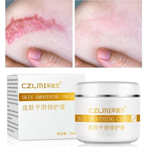 Effective Prevention Stretch Marks Remover And Scar Removal Postpartum Obesity Pregnancy Scar Marks Effectively Heal Cream TSLM1
