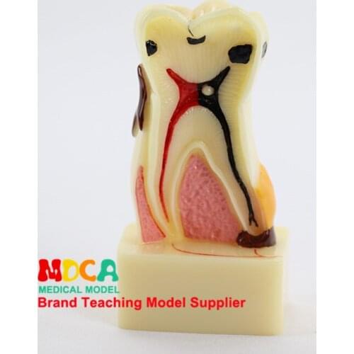Dental pathological anatomy model dental caries gingival display medical teaching model MYC009