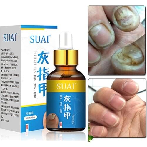 Nail Fungal Treatment Feet Care Essence Nail Foot Whitening Toe Nail Fungus Removal Gel Anti Infection Paronychia Onychomycosis