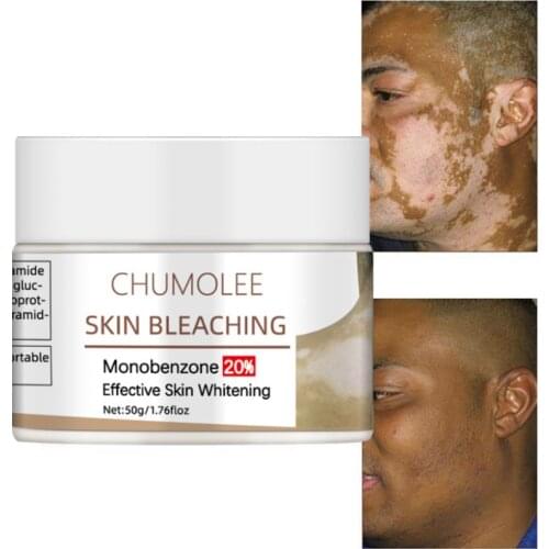 Chumolee Monobenzone 20% Skin Bleaching Face Whitening Cream White Spot Vitiligo Treament Fade Dark Spots Age Spot