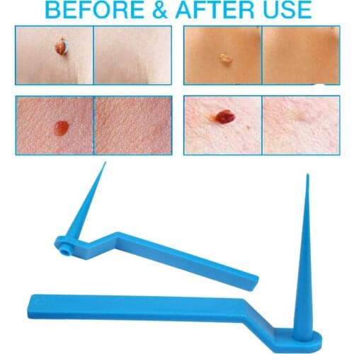 Skin Tag Kill Skin Mole Wart Remover Micro Band Skin Tag Removal Kit With Cleansing Swabs Adult Mole Wart Face Care