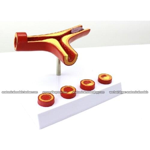 CMAM/12482 Heart- Atherosclerosis and Thrombosis Model, Human Heart Medical Teaching Anatomical Model