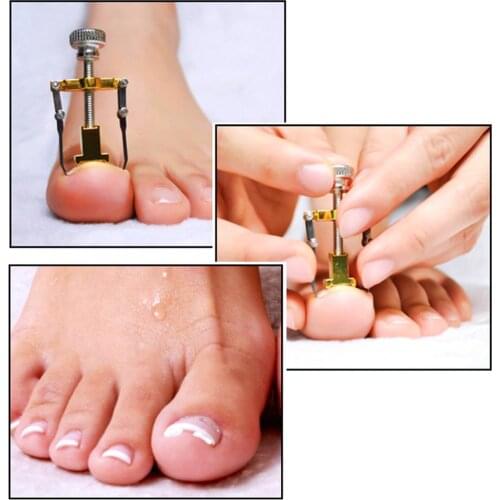 Ingrown Toenail Straightening Clip Treatment Paronychia Recover Tool Toe Corrector Ingrown Toenail Fixer for Nails Toe