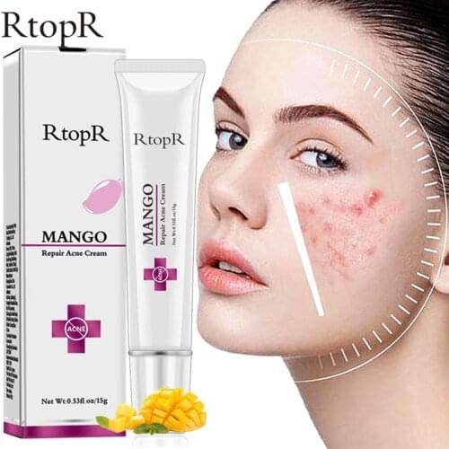 RtopR Mango Acne Treatment Face Cream Blackhead Repair Gel Oil Control Shrink Pores Scar Removal Anti Acne Face Cream Skin Care