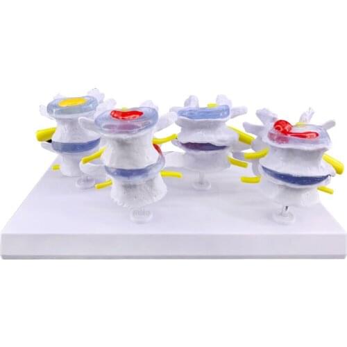 4 pcs Intervertebral Disc Spine Pathological Lumbar Spine Model Human Skeleton Model Teaching Intervertebral Disc Spine