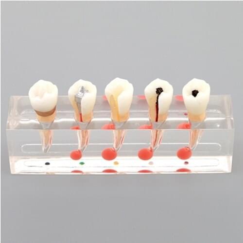 1PC Dental Teeth Model Detachable Premolar teeth caries Education Study model