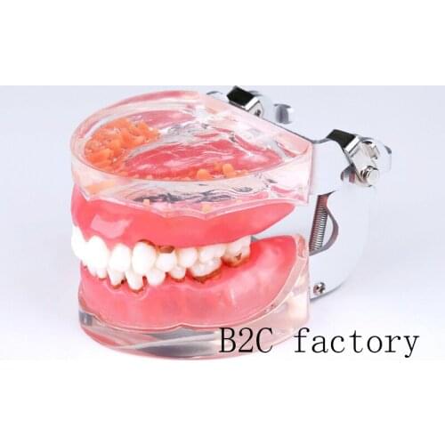 New Dental Typodont Teeth Model Adult Pathological Periodontal disease 4017