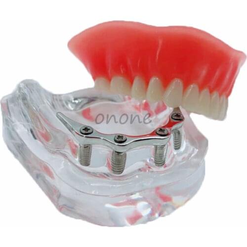 1pcs Dental Implant Restoration Model With Silver Metal Rod 4 Planting Nails Student Learning Teaching Model